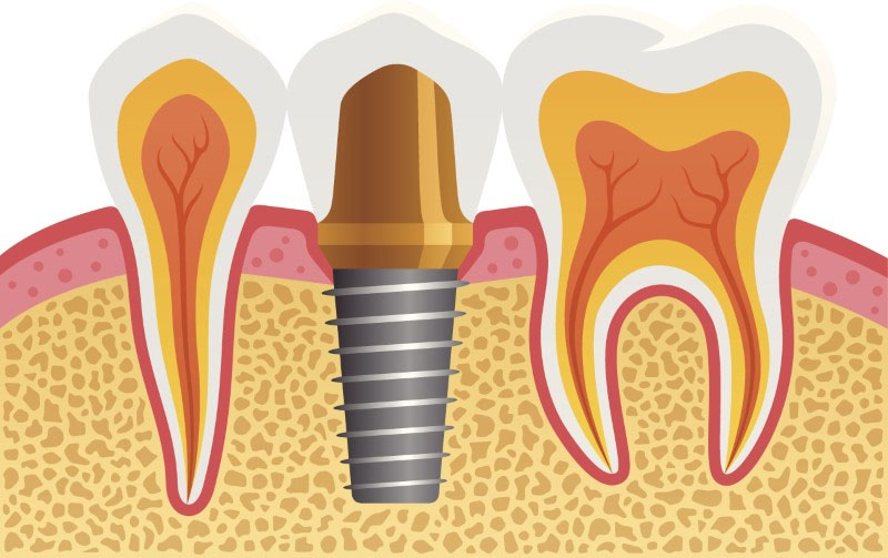 Dental Implants